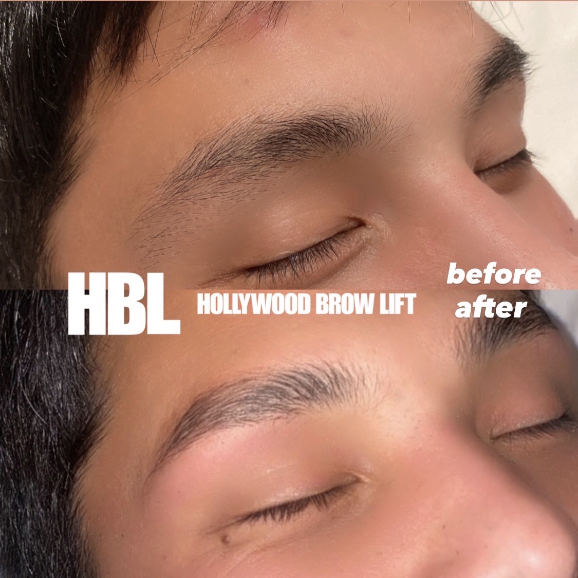 Hollywood Brow Lift(HBL)とは リンパドレナージュ ラニカイ